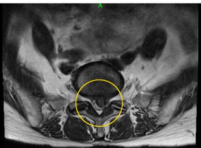 吹田、摂津千里丘の椎間板ヘルニア患者さん